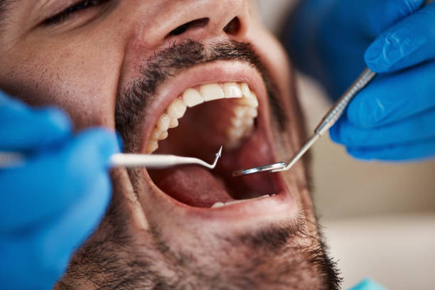 Best Dental Fillings (Composite and Amalgam)  in Hope, IN